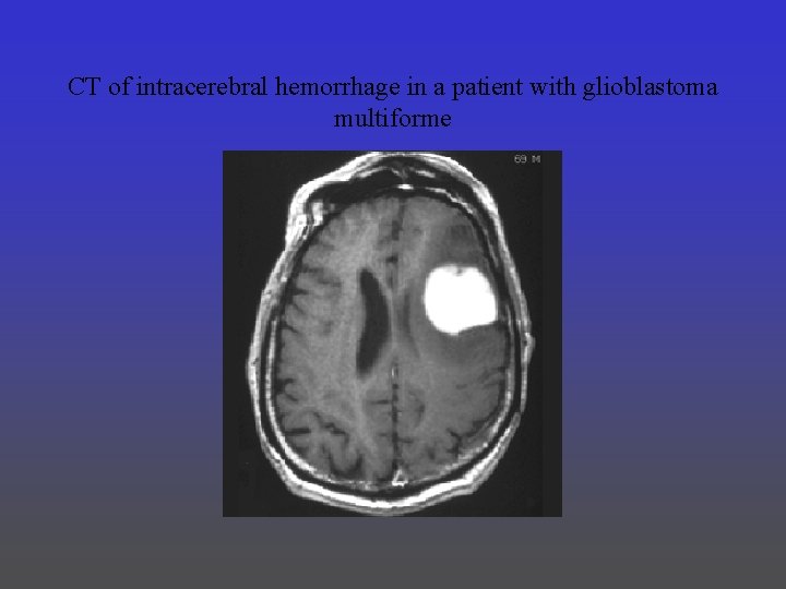 CT of intracerebral hemorrhage in a patient with glioblastoma multiforme 