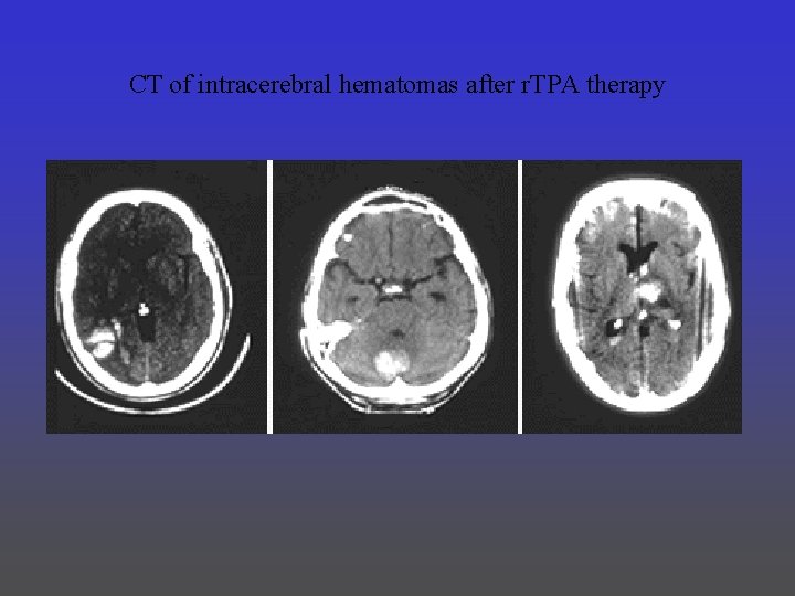 CT of intracerebral hematomas after r. TPA therapy 