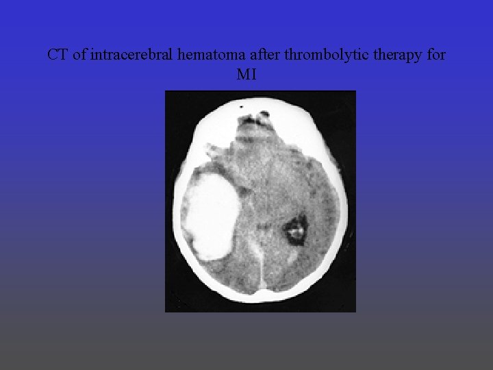 CT of intracerebral hematoma after thrombolytic therapy for MI 