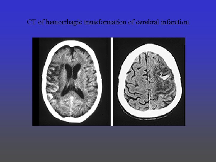 CT of hemorrhagic transformation of cerebral infarction 