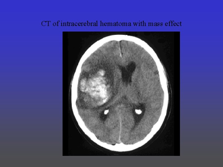 CT of intracerebral hematoma with mass effect 