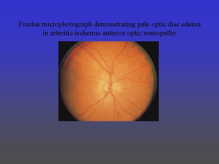 Fundus microphotograph demonstrating pale optic disc edema in arteritic ischemic anterior optic neuropathy 