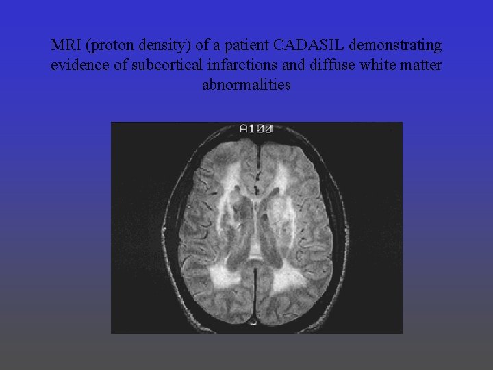 MRI (proton density) of a patient CADASIL demonstrating evidence of subcortical infarctions and diffuse