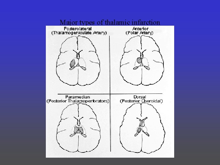 Major types of thalamic infarction 