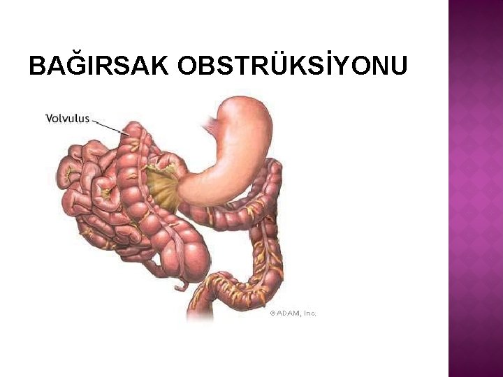 BAĞIRSAK OBSTRÜKSİYONU 