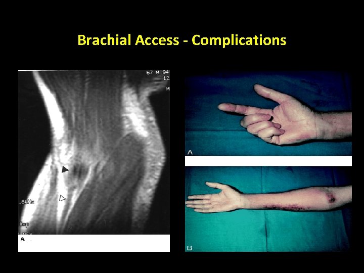 Brachial Access - Complications 