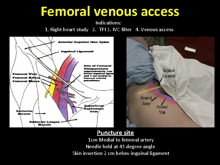 Femoral venous access Indications: 1. Right heart study 2. TPI 3. IVC filter 4.