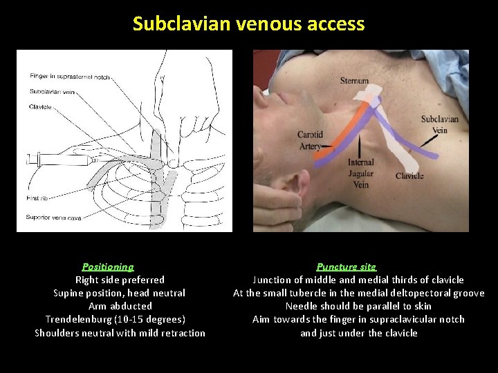 Subclavian venous access Positioning Right side preferred Supine position, head neutral Arm abducted Trendelenburg