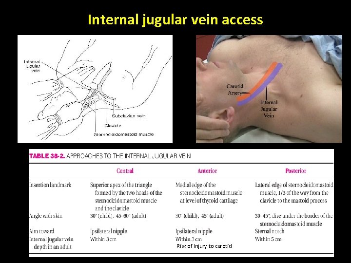 Internal jugular vein access Risk of injury to carotid 