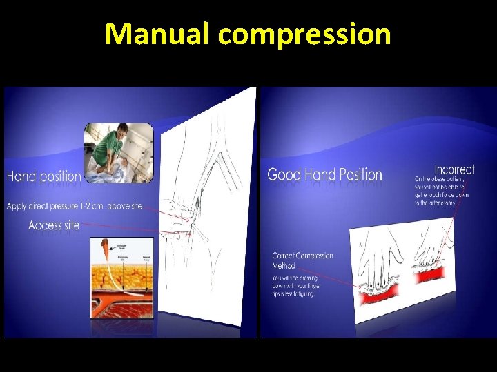 Manual compression 
