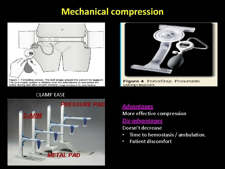 Mechanical compression CLAMP EASE PRESSURE PAD Advantages More effective compression C-ARM Dis-advantages Doesn’t decrease