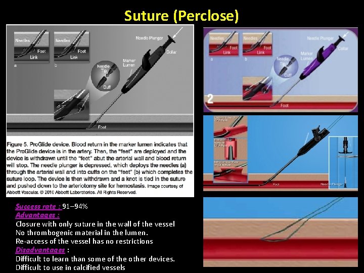 Suture (Perclose) Success rate : 91– 94% Advantages : Closure with only suture in