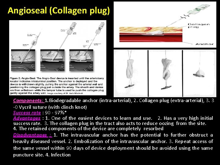 Angioseal (Collagen plug) Components: 1. Biodegradable anchor (intra-arterial), 2. Collagen plug (extra-arterial), 3. 3