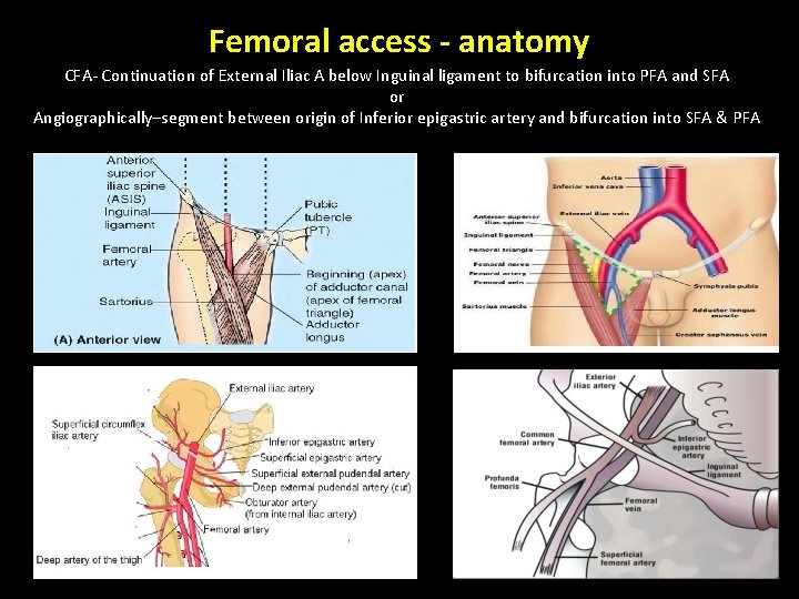 Femoral access - anatomy CFA- Continuation of External Iliac A below Inguinal ligament to