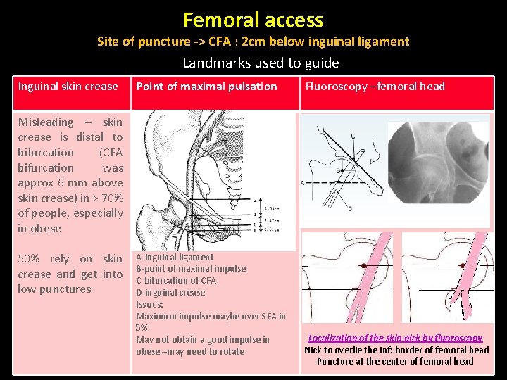 Femoral access Site of puncture -> CFA : 2 cm below inguinal ligament Landmarks