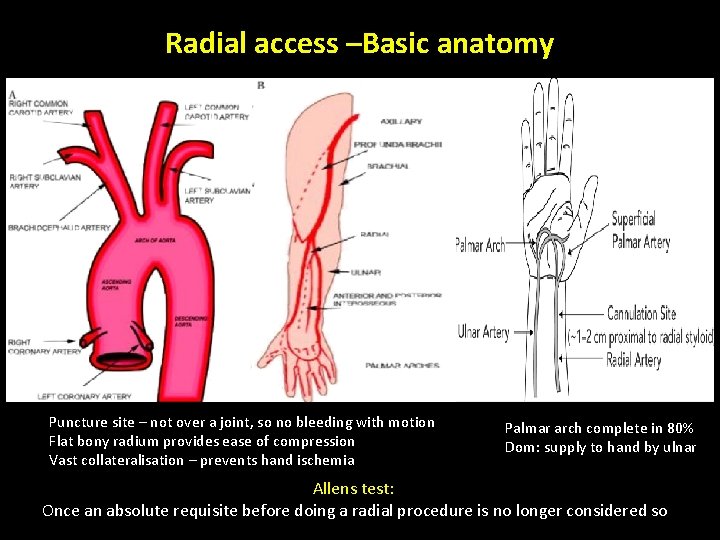 Radial access –Basic anatomy Puncture site – not over a joint, so no bleeding