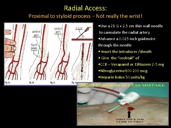 Radial Access: Proximal to styloid process – Not really the wrist! • Use a