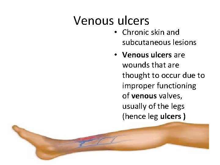 Venous ulcers • Chronic skin and subcutaneous lesions • Venous ulcers are wounds that