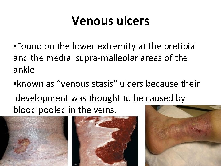 Venous ulcers • Found on the lower extremity at the pretibial and the medial