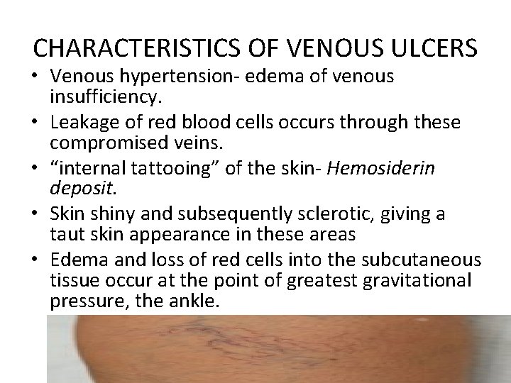 CHARACTERISTICS OF VENOUS ULCERS • Venous hypertension- edema of venous insufficiency. • Leakage of