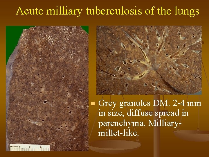 Acute milliary tuberculosis of the lungs n Grey granules DM. 2 -4 mm in