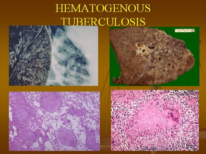 HEMATOGENOUS TUBERCULOSIS 