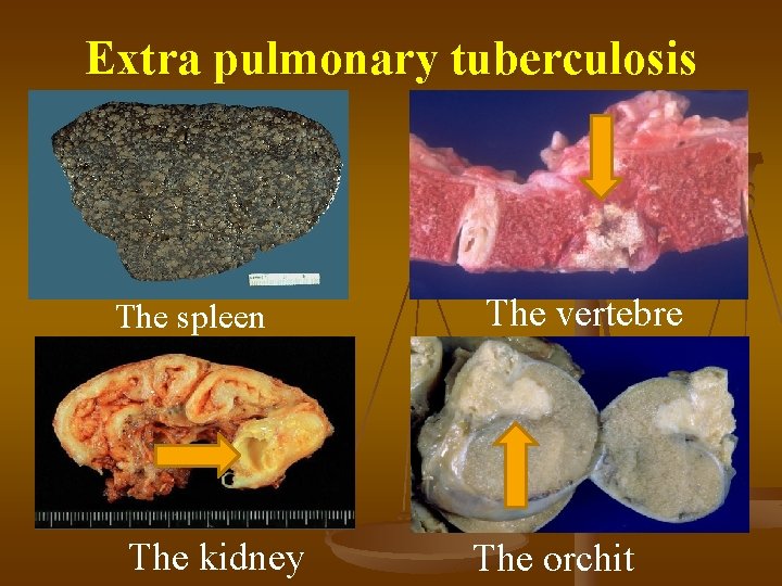 Extra pulmonary tuberculosis The spleen The kidney The vertebre The orchit 