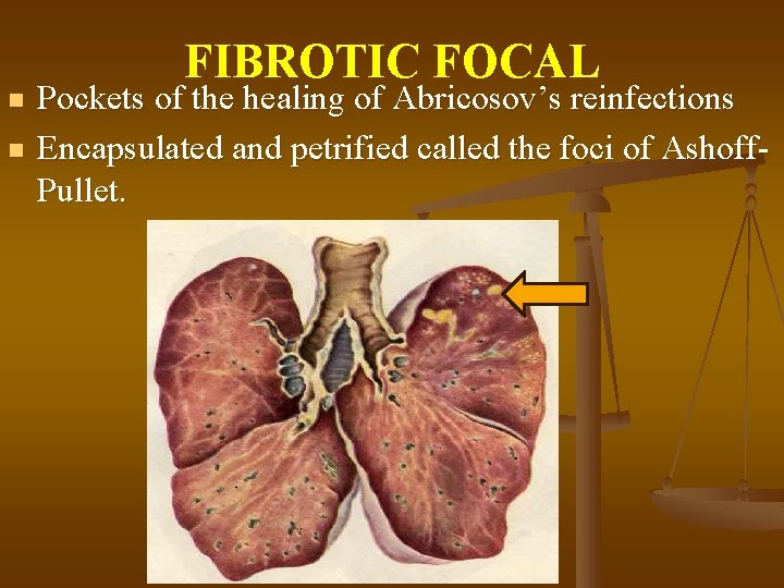 n n FIBROTIC FOCAL Pockets of the healing of Abricosov’s reinfections Encapsulated and petrified