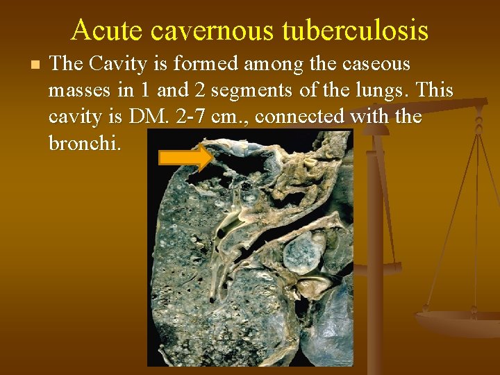 Acute cavernous tuberculosis n The Cavity is formed among the caseous masses in 1