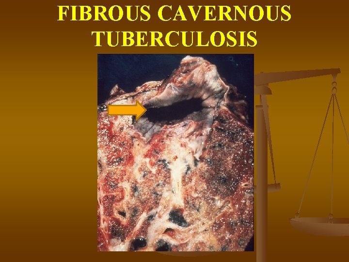 FIBROUS CAVERNOUS TUBERCULOSIS 