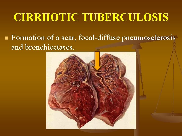 CIRRHOTIC TUBERCULOSIS n Formation of a scar, focal-diffuse pneumosclerosis and bronchiectases. 