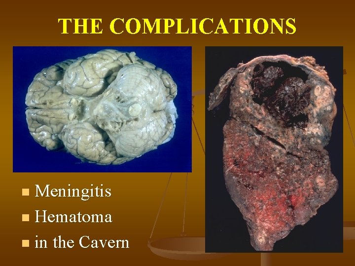THE COMPLICATIONS Meningitis n Hematoma n in the Cavern n 