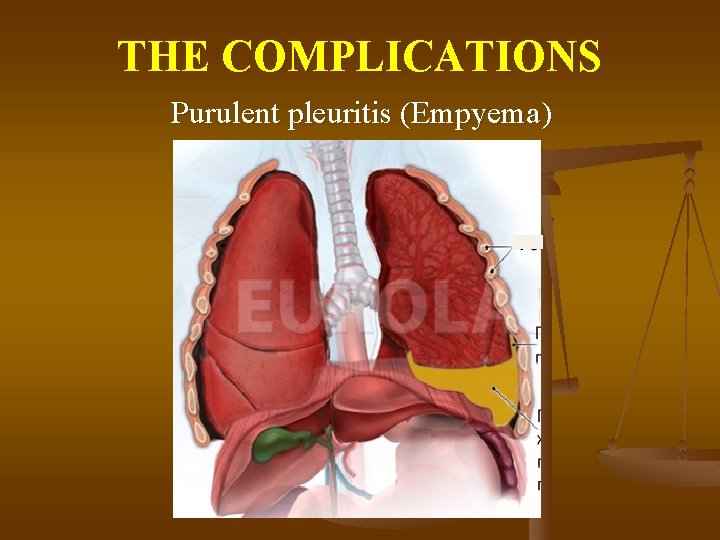 THE COMPLICATIONS Purulent pleuritis (Empyema) 
