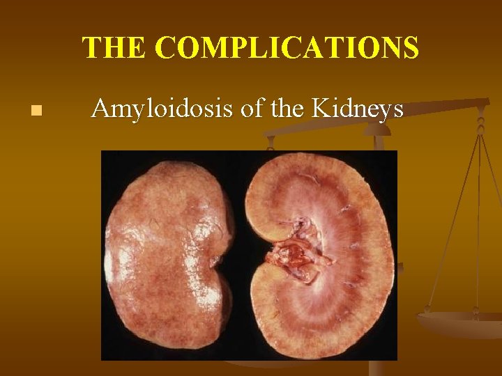 THE COMPLICATIONS n Amyloidosis of the Kidneys 