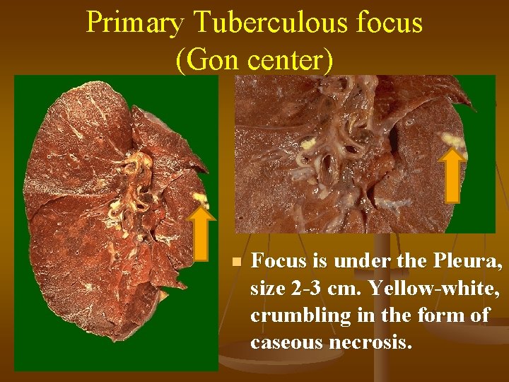 Primary Tuberculous focus (Gon center) n Focus is under the Pleura, size 2 -3