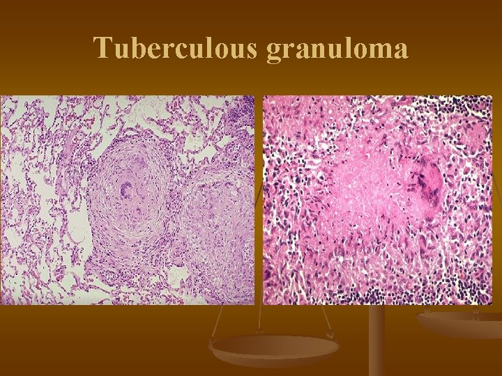 Tuberculous granuloma 