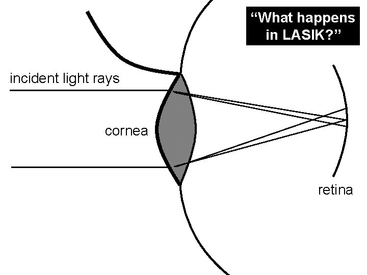 “What happens in LASIK? ” incident light rays cornea retina 