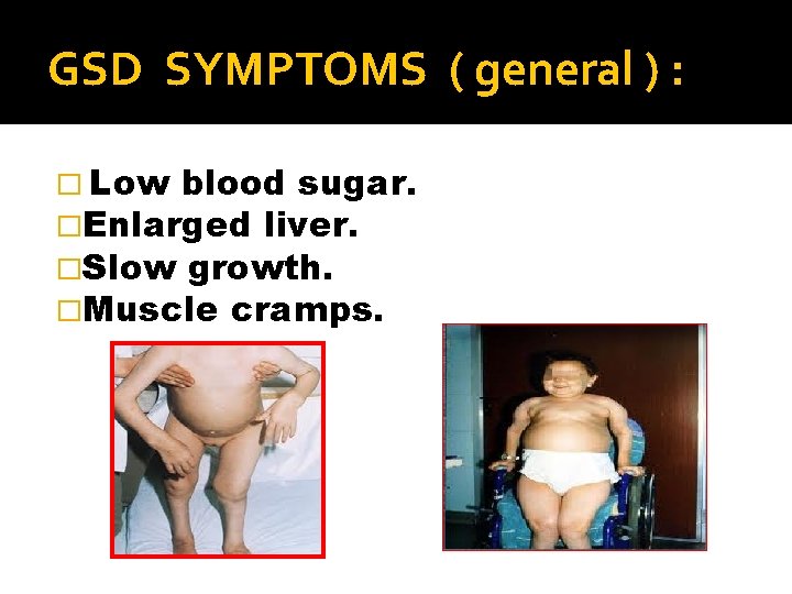 GSD SYMPTOMS ( general ) : � Low blood sugar. �Enlarged liver. �Slow growth.
