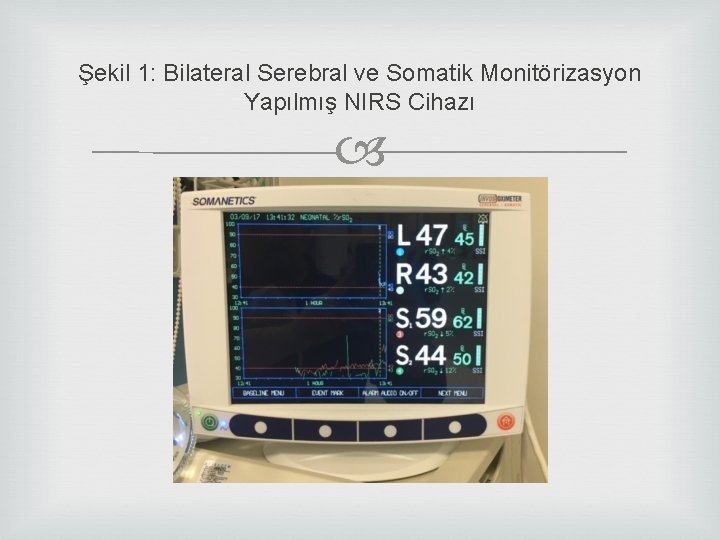 Şekil 1: Bilateral Serebral ve Somatik Monitörizasyon Yapılmış NIRS Cihazı 