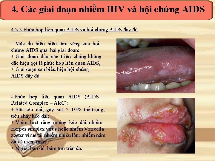 4. Các giai đoạn nhiễm HIV và hội chứng AIDS 4. 2. 2 Phức