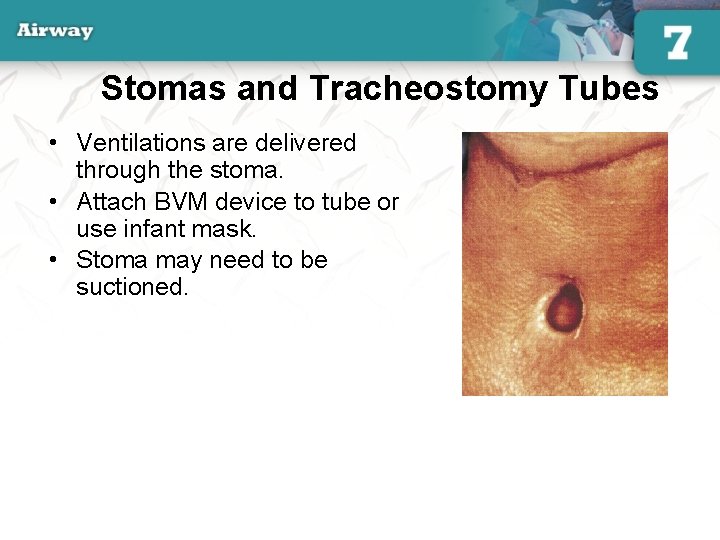 Stomas and Tracheostomy Tubes • Ventilations are delivered through the stoma. • Attach BVM