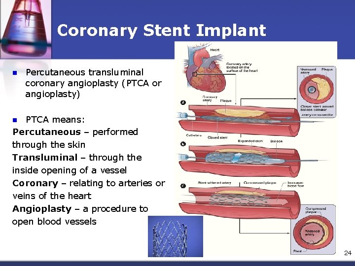 Coronary Stent Implant n Percutaneous transluminal coronary angioplasty (PTCA or angioplasty) PTCA means: Percutaneous