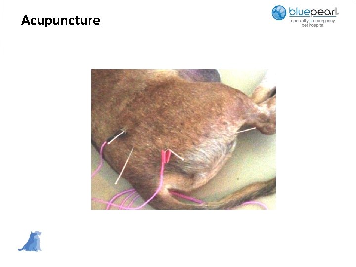 Acupuncture 