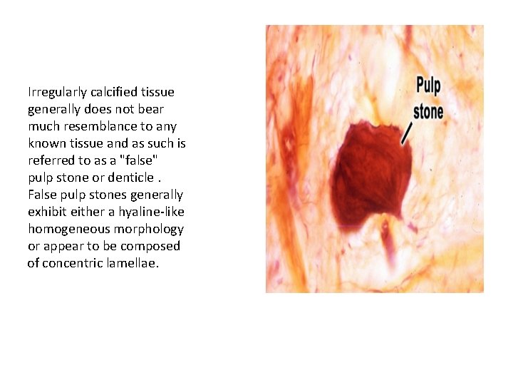 Irregularly calcified tissue generally does not bear much resemblance to any known tissue and