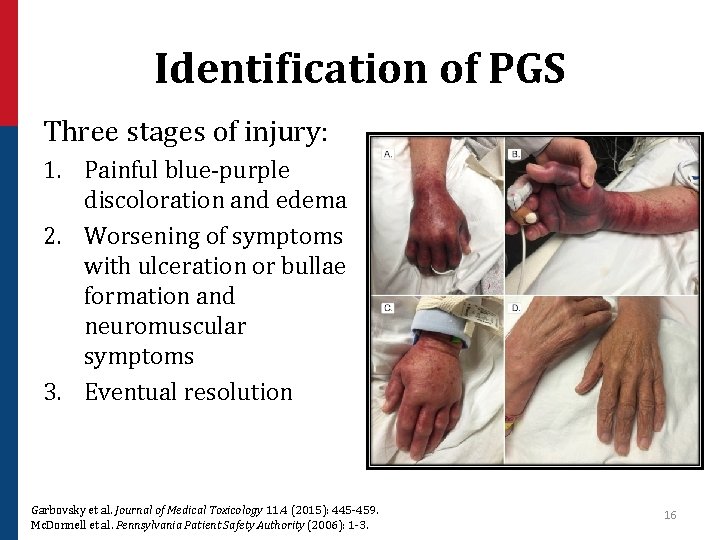 Identification of PGS Three stages of injury: 1. Painful blue-purple discoloration and edema 2.
