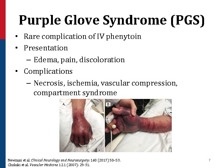 Purple Glove Syndrome (PGS) • Rare complication of IV phenytoin • Presentation – Edema,