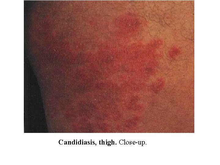 Candidiasis, thigh. Close-up. 