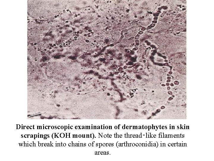 Direct microscopic examination of dermatophytes in skin scrapings (KOH mount). Note thread‑like filaments which