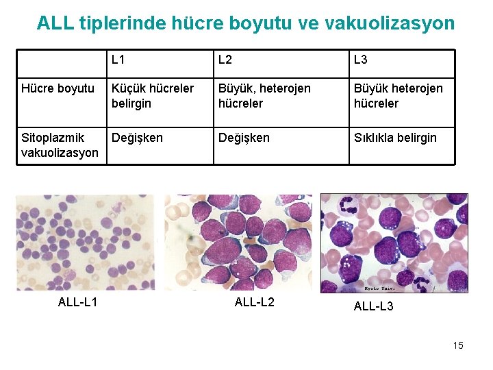 ALL tiplerinde hücre boyutu ve vakuolizasyon L 1 L 2 L 3 Hücre boyutu