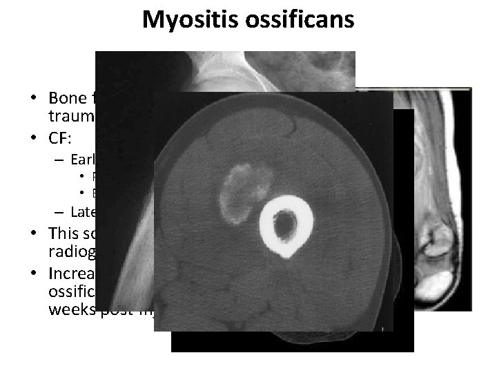 Myositis ossificans • Bone formation within muscle secondary to blunt trauma. • CF: –